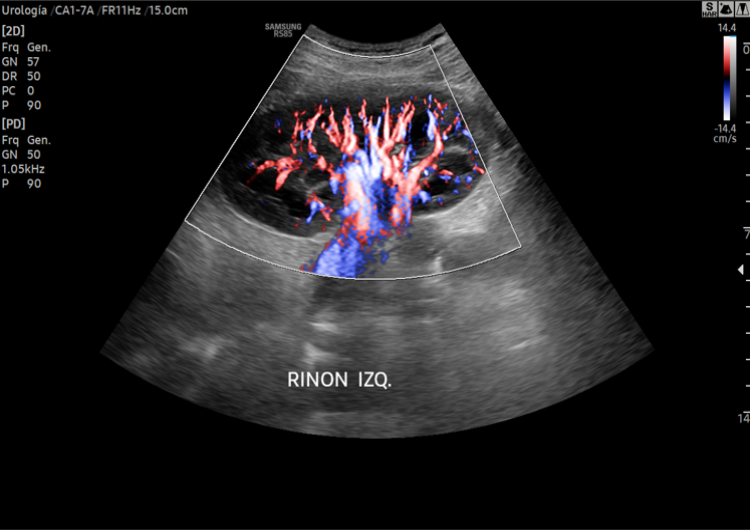 Doppler Renal
