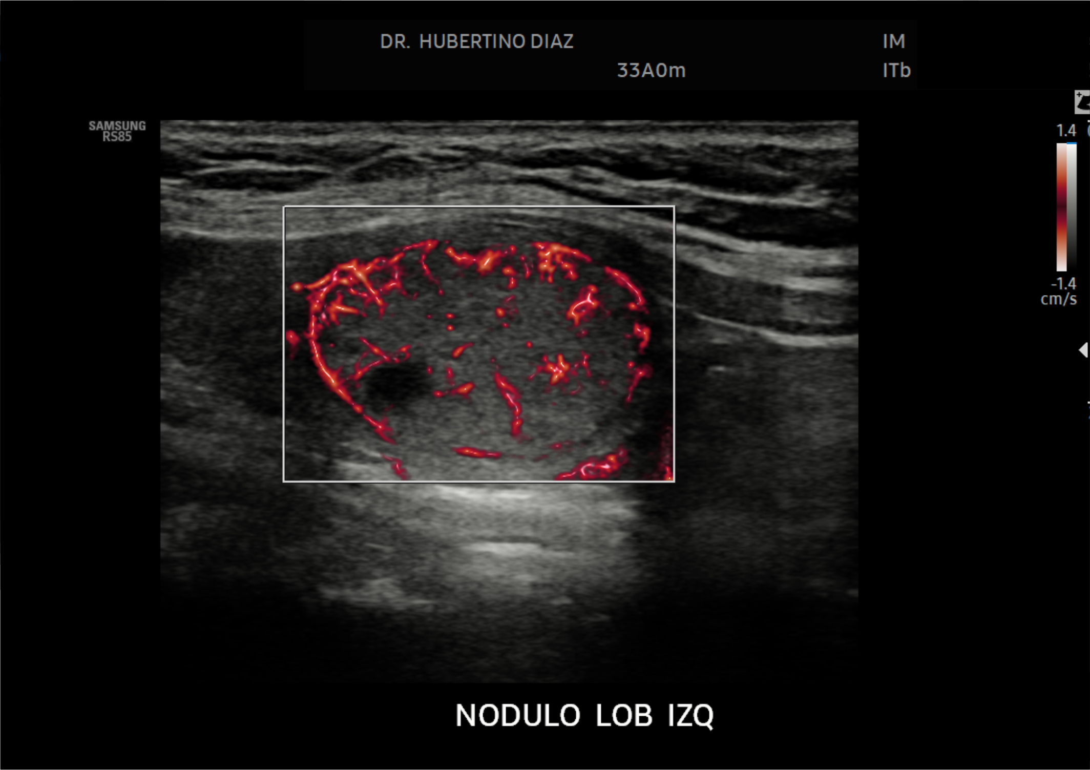 Doppler Microflujo de Tiroides
