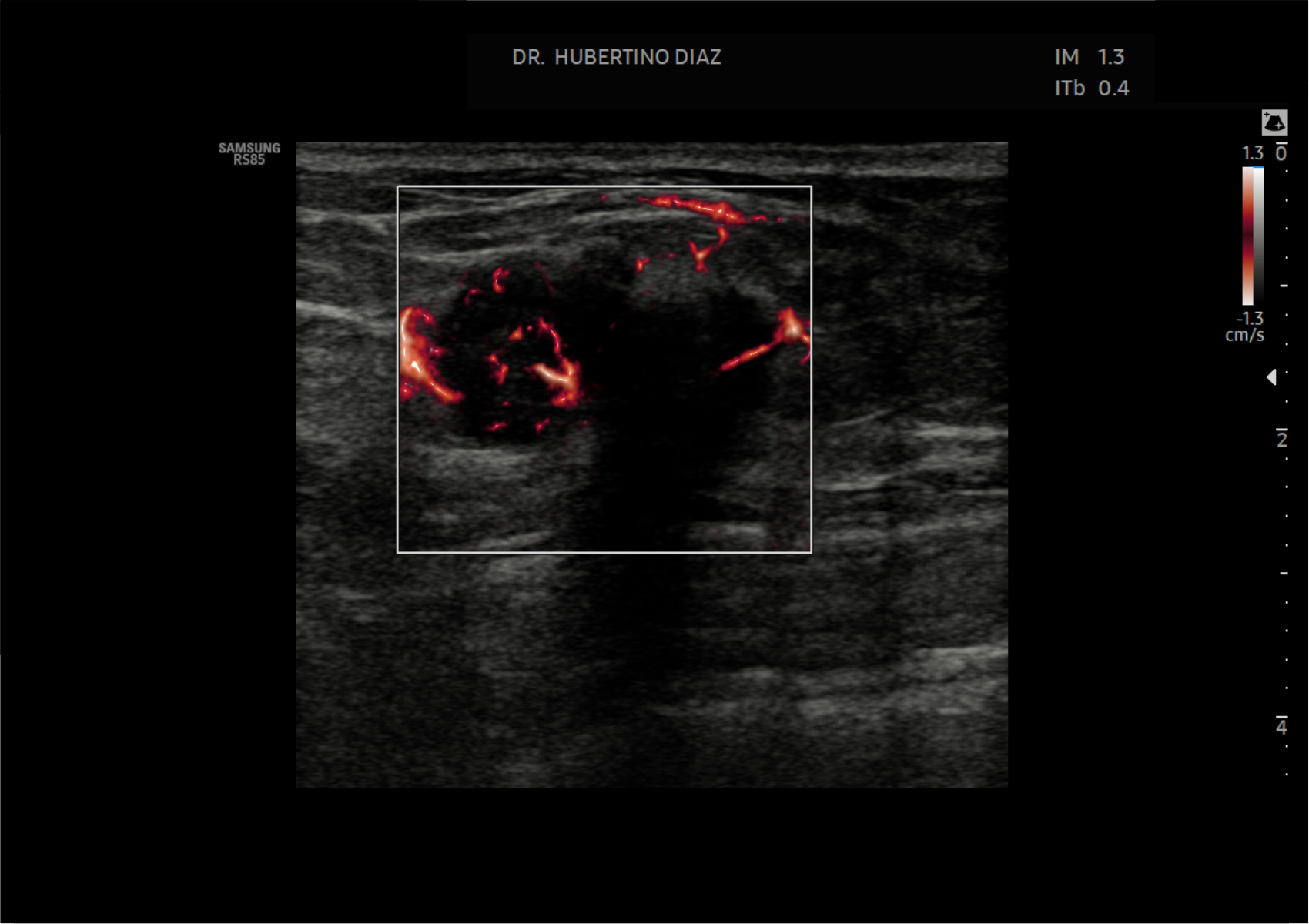 Doppler Microflujo de Mama