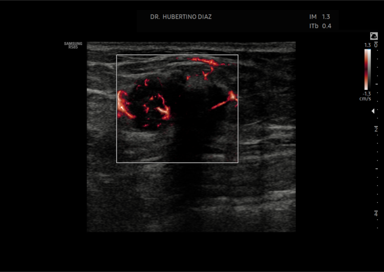 Doppler de Mama (Microflujo)