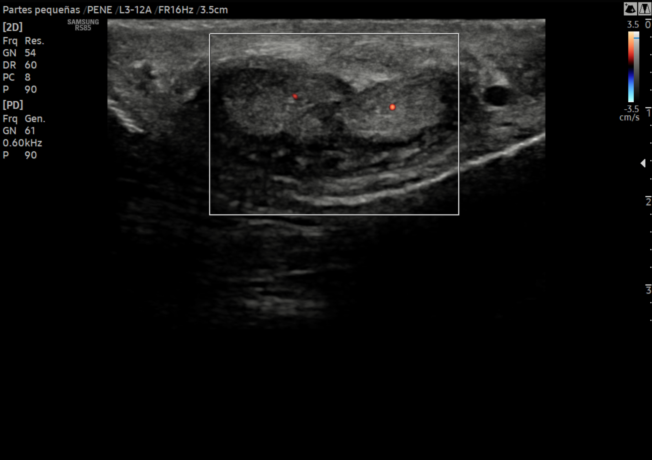 Doppler de Pene sin Sustancia Vasoactiva