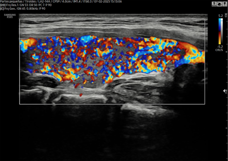Doppler Microflujo de Tiroides