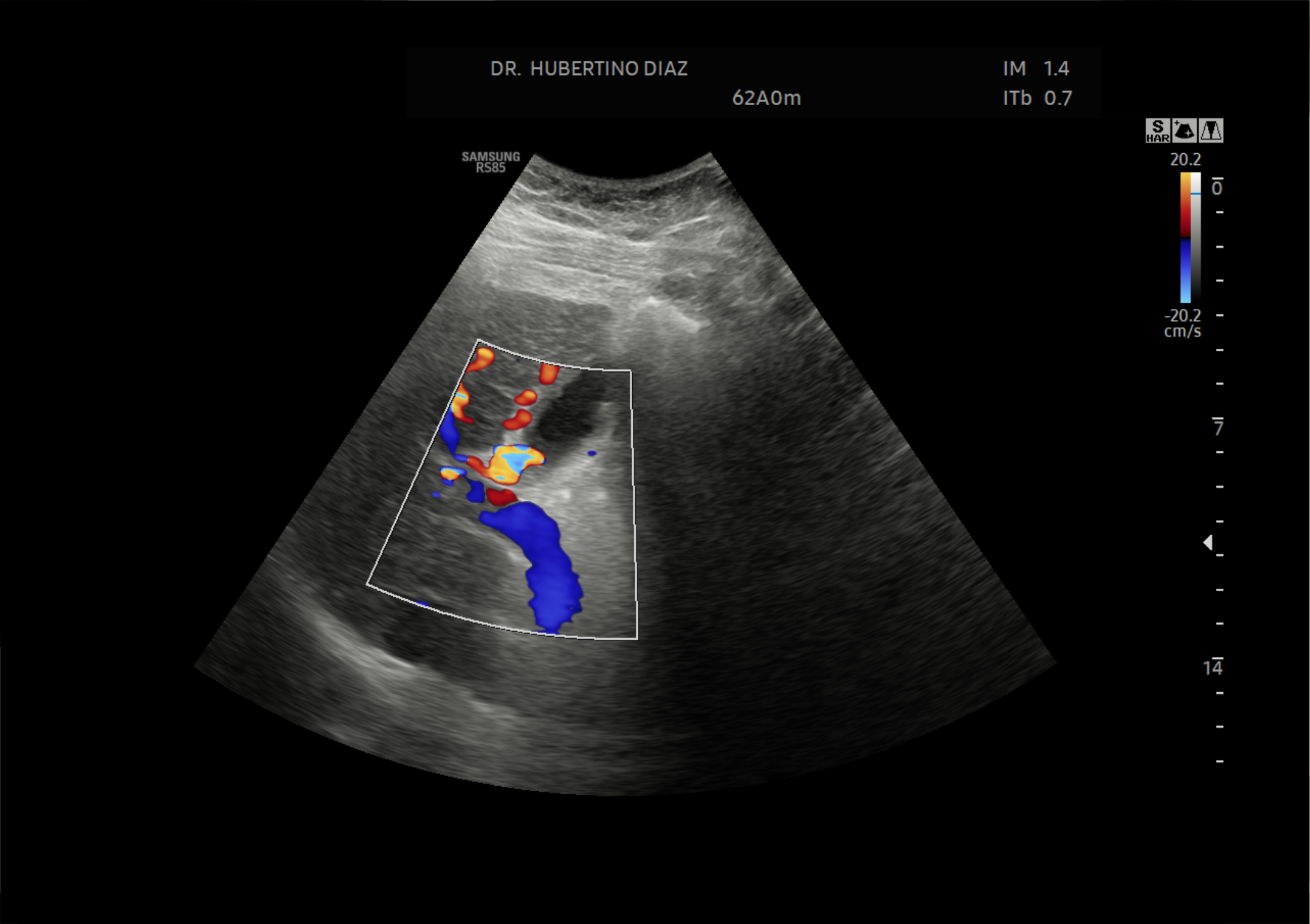 Doppler de Hígado - Hipertensión portal