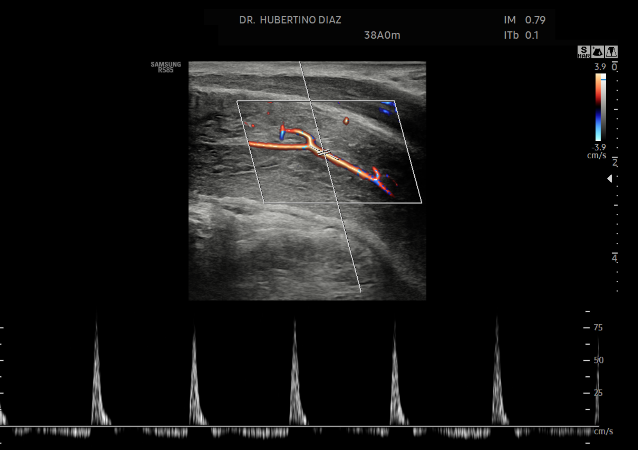 Doppler de Pene con Sustancia Vasoactiva