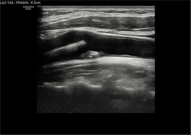 Doppler de Carótidas y Arterias Vertebrales