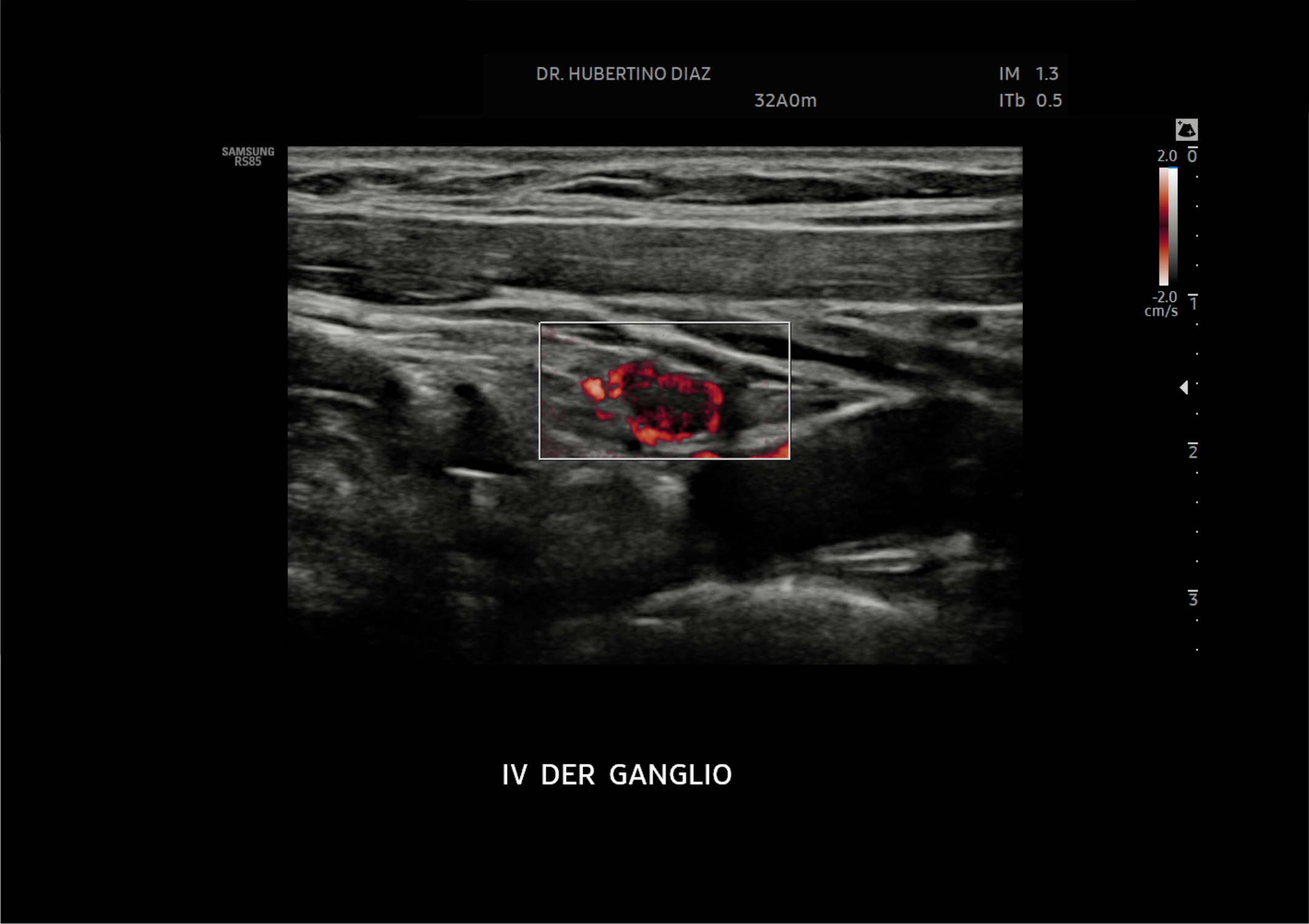 Doppler de Ganglios Linfáticos