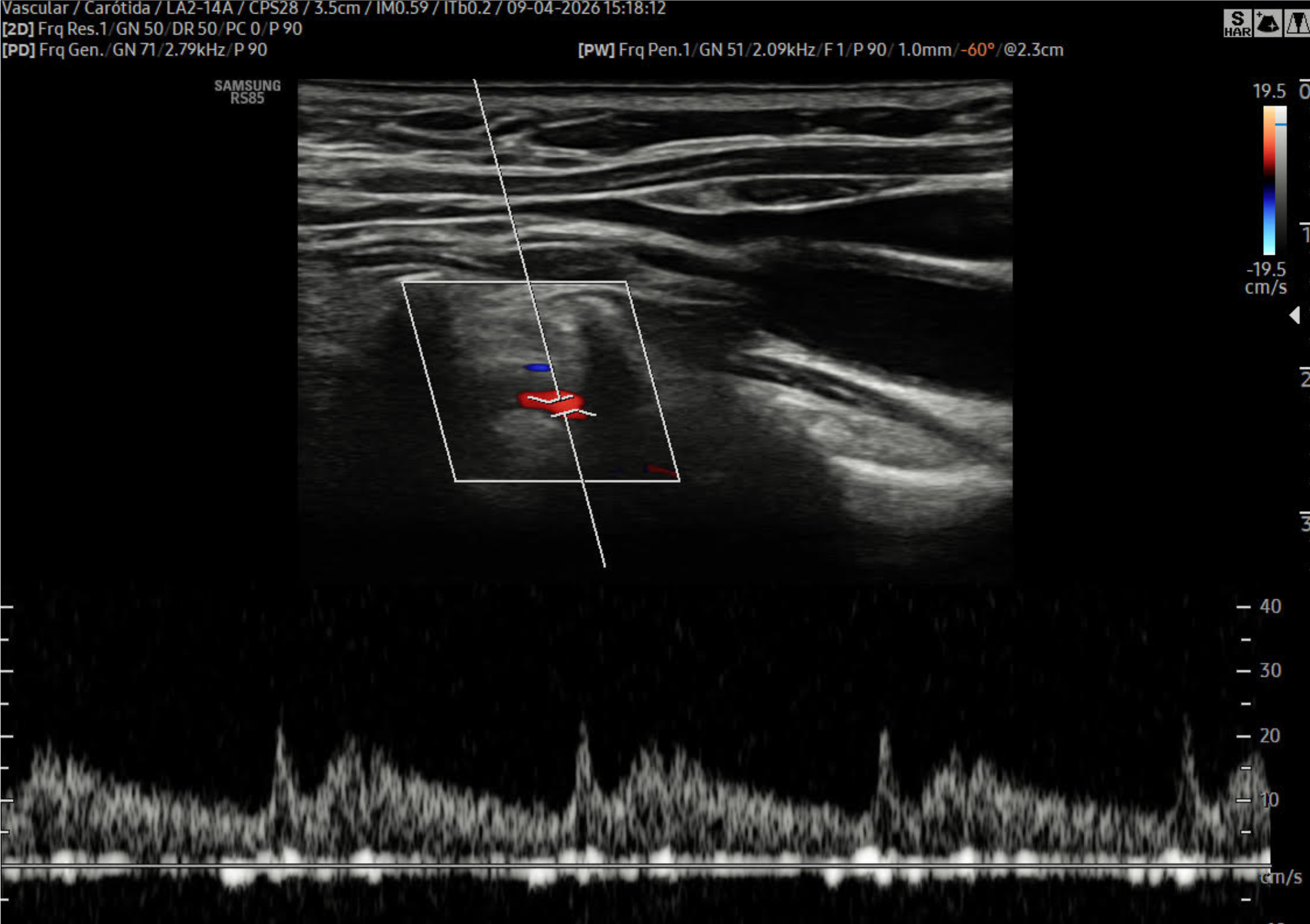Doppler de Carótidas y Arterias Vertebrales